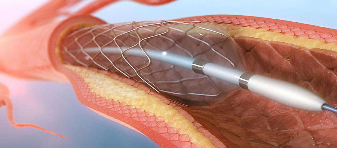 آنژیوپلاستی در کرج
