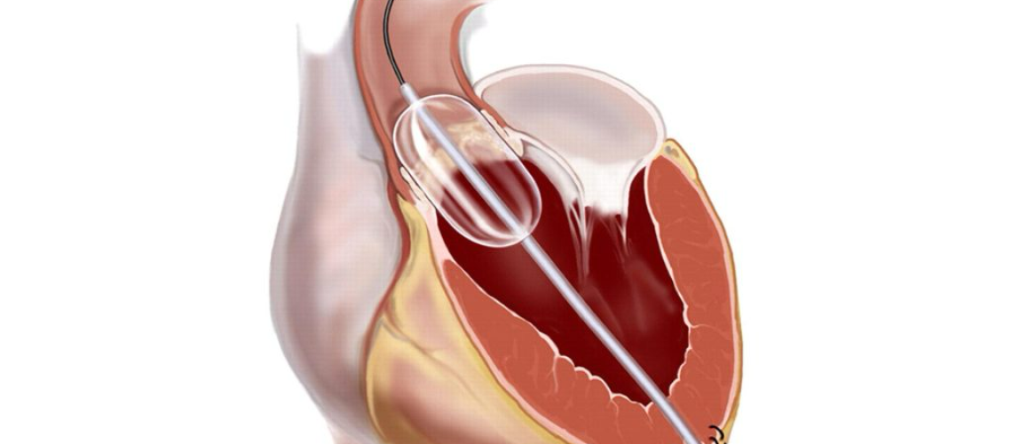 بالون دریچه میترال در تهران