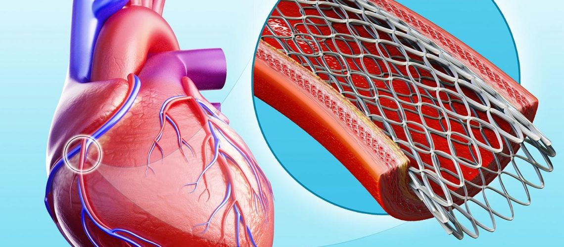 دکتر استنت گذاری در اهواز