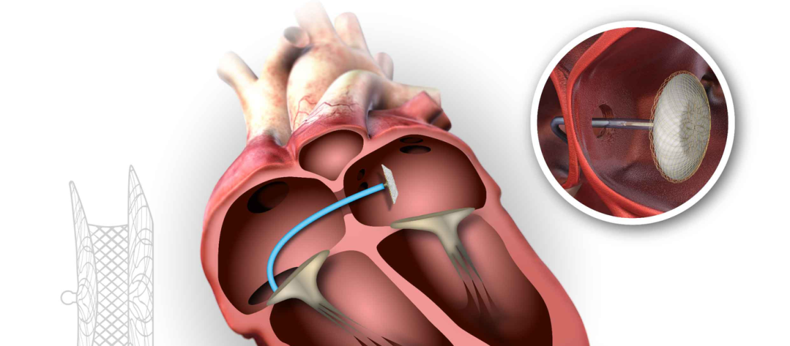 نقص سپتوم دهلیزی در کرمان