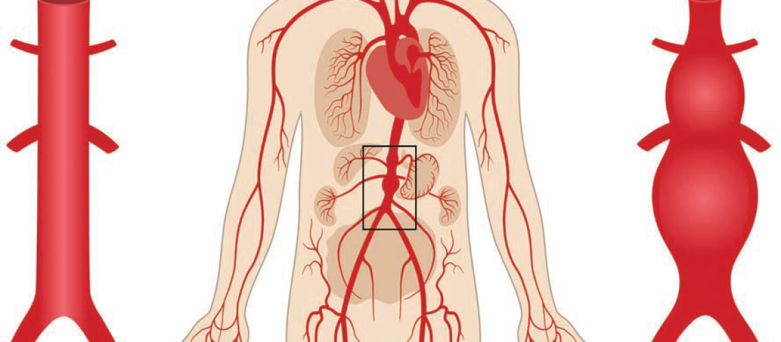 پاره شدن آئورت در اصفهان
