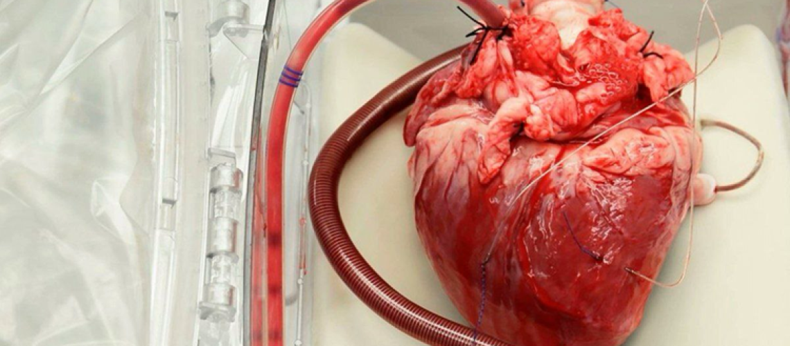 پیوند قلب در مشهد